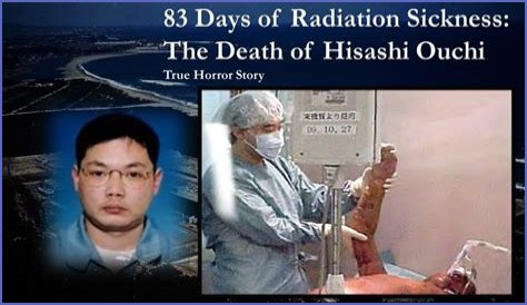 The Devastating Aftermath: Hisashi Ouchi's Autopsy Reveals Extent Of Radiation Damage